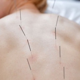 Akupunktura
